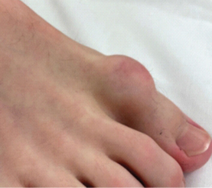 Figure 1: Pre-operative clinical presentation of fibro-osseous pseudotumor of the digit in the right foot’s hallux.