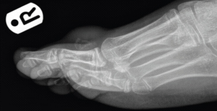 Figure 2a: Lateral radiograph of foot demonstrating soft tissue lesion with calcification and dorsal scalloping of bone