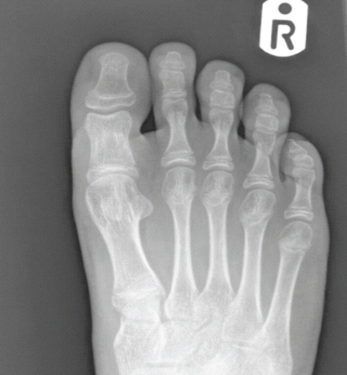 Figure 2b: AP radiopgraph of foot showing soft tissue lesion with no coronal deformity or involvement of physis