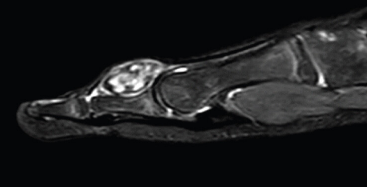 Figure 3a: Sagittal STIR sequence MRI showing a well-defined ovoid-shaped ossified body overlying the proximal phalanx of the hallux underneath the EHL tendon.