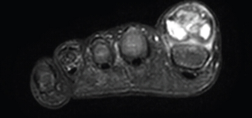 Figure 3b: Axial STIR sequence MRI showing a lesion underneath the EHL tendon of the great toe.