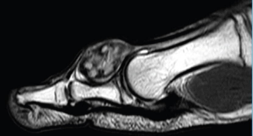 Figure 3c: Sagittal T2 MRI showing lesion with obvious scalloping of dorsal aspect proximal phalanx great toe.