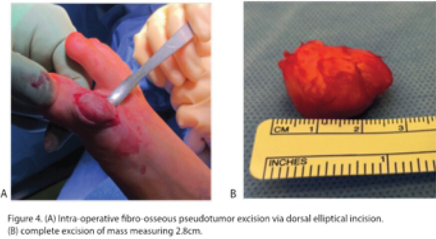 Figure 4: (A) Intraoperative fibro-osseous pseudotumor excision versus corsal elliptical incision. (B) Complete excision of a mass measuring 2.8 cm.