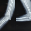 A Rare Repair: Trochlear Fracture Fixed With Headless Screws and Medial Epicondyle Osteotomy – A Case Report