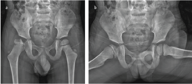 From Hip Effusion To Hemophilia Unveiling The Cause Of Pain In 6 Month From Hip Effusion To Hemophilia Unveiling The Cause Of Pain In 6 Month