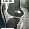 Clinical and Radiological Outcomes of All-inside Versus Complete Tibial Tunnel Techniques in Anterior Cruciate Ligament Reconstruction using Hamstring Tendon Autograft: A Prospective Comparative Study