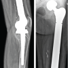 “Whoops Procedure” an Iatrogenic Indication for Total Femur Replacement in a Young Patient with Osteosarcoma. A Case Report
