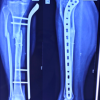 Locking Plate Fixators for Infected Extra-articular Long Bone Fractures without Bone Loss