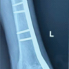 Comparing Locking Compression Plate and Retrograde Nail in the management of distal femur fracture: A Comprehensive Analysis