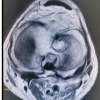 Sub-acute Septic Arthritis of the Knee by Candida vishwanathii: Two Rare Case Reports and Review of Literature