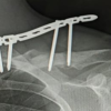 Definitive Management of Open Clavicle Fracture with Locking Compression Plate as External Fixator