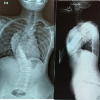 A Rare Case of Intramedullary Spinal Cord Ganglioglioma with Scoliosis