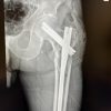 Simultaneous Bilateral Extracapsular Proximal Femur Fracture in an 85-year-old Male Patient. A Case Report
