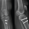 Stress Fracture after Tibial Tuberosity Osteotomy – Analyzing the Contributing Factors