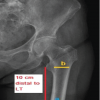 Femoral Stem Subsidence Rate with Cementless Stems in Patients with Sub-capital Femoral Neck Fractures: Relationship to Proximal Femoral Geometry
