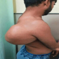 Figure 1: Clinical image of the swelling. The swelling is massive in size. It causes significant mechanical compression of the neurovascular structures.