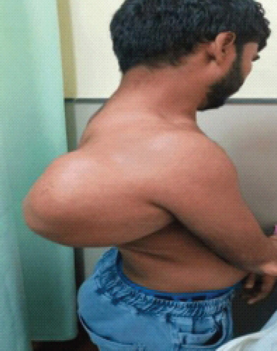 Figure 1: Clinical image of the swelling. The swelling is massive in size. It causes significant mechanical compression of the neurovascular structures.