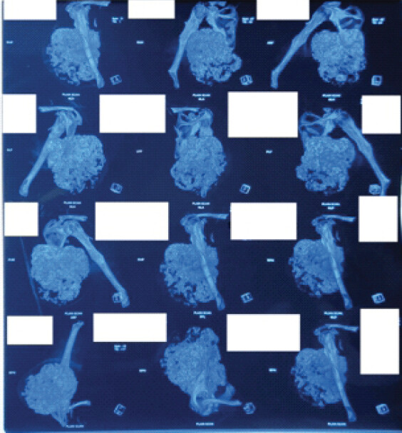 Figure 2: 3D CT scan of the scapula. The 3D CT scan provides an appropriate pre operative planning picture of the swelling. The location, extent and size of the tumor can be clearly delineated. CT: Computed tomography.