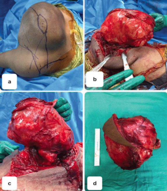 Figure 3: Surgical excision of the tumor. (a) The patient is positioned prone on the operating table and skin marking done. (b) It is very important to properly expose the tumor and reach its base and ablate it to prevent recurrence. (c)The base of the tumor exposed. (d) The tumor after removal and measured with the surgical scale. The redundant skin should be removed to prevent the formation of dead space and hematoma after surgery.