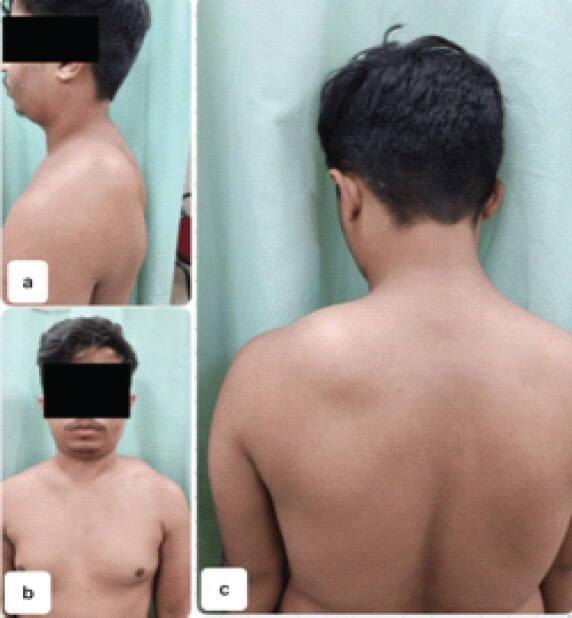 Figure 4: Swelling on the dorsum of left Scaplua. The detailed physical examination reveals the swelling is originating from the scapula. Given the location of swelling it can be misleading to assume its origin and should be confirmed with imaging. (a) The swelling when viewed from side, (b) from front (c) from back.