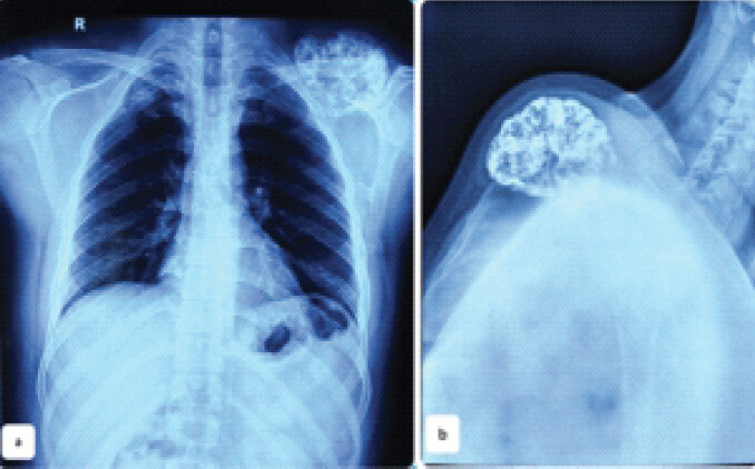 Figure 5: X-ray chest and scapula. Radiographs in different angles guides us to the origin of the swelling and gives a primary idea of the type of the swelling. (b) Antero-posterior view and (b) Lateral view.