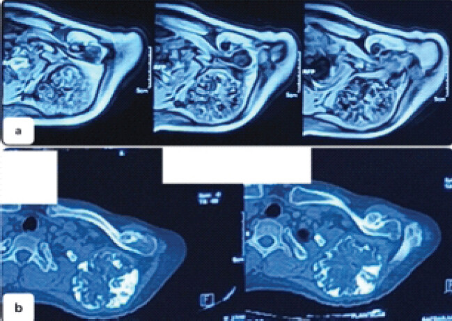 Figure 6: (a) CT scan and (b) MRI of the shoulder and scapula. (a) CT scan and figure (b) MRI confirms the diagnosis and helps to evaluate the extent of the tumor and aids in preoperative planning. CT: Computed tomography, MRI: Magnetic resonance imaging.