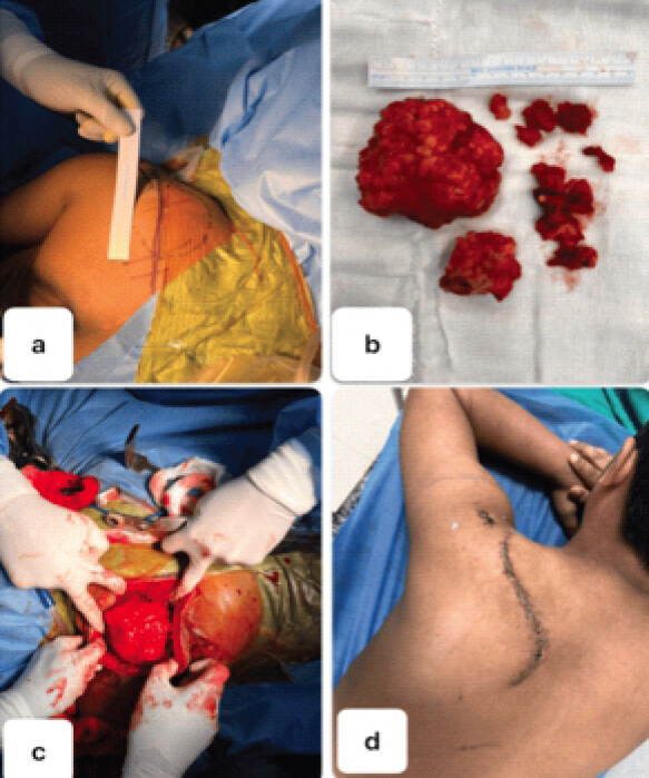 Figure 7: Surgical excision of the tumor. Gentle dissection to the base of the tumor. The excised tumor is sent for histopathological examination. (a) Preoperative surgical marking. (b) The excised tumor. (c) The tumor. (d) Post-operative surgical site. The redundant skin is removed and closure done to decrease the chances of dead space formation.