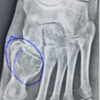Case Series: Outcome of Giant Cell Tumor in Small Bones of the Foot