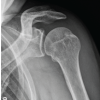 Combined Anterior Latissimus Dorsi and Teres Major Tendon Transfer for Anterosuperior Irreparable Rotator Cuff Tears in One-Arm Patients: A Case Report