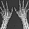 Bilateral Traumatic Scaphoid Fracture Managed Surgically with Headless Compression Screw: A Case Report with Review Literature