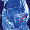 Distal Fibula Osteochondroma with Peroneal Tendon Subluxation – A Case Report