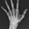 Atypical Extensor Tenosynovitis: Case Report and Literature Review