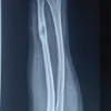Unveiling the Uncommon – A Rare Skeletal Encounter of Tuberculosis of the Ulna Diaphysis in an Adult Female Patient
