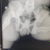 Bilateral Simultaneous Anterior Obturator and Pubic Dislocation of the Hip: A Case Report and Literature Review