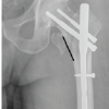 Impact of Tip Apex Distance, Cortical Reduction, and Lateral Wall Integrity on Radiological Union of Unstable Trochanter Fracture Treated with Proximal Femoral Nail: A Retrospective Observational Study