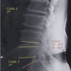 Do Spino-pelvic Parameters Predict Development of Spondylolisthesis in Degenerative Disc Disease at the L4-5 Level