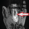 An Uncommon Etiology for a Common Condition: Giant Cell Tumor of the Tendon Sheath Presenting as Trigger Finger: A Case Report and Review of the Literature