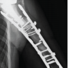 Revision of Cemented Reverse Total Shoulder Arthroplasty with Bone Graft in Osteogenesis Imperfecta: A Case Report