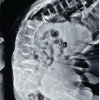 A Dark Turn in the OR: Incidental Discovery of Ochronosis during Trauma Surgery: A Case Report