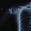 A Twist in the Shoulder Tale: Proximal Humerus Fracture Following Trapezius Transfer – A Case Report