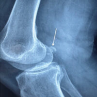 Figure 1: X-ray of the knee revealed the sesamoide bone (arrow).