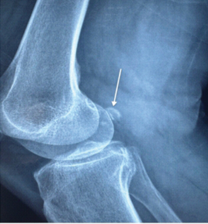 Figure 1: X-ray of the knee revealed the sesamoide bone (arrow).