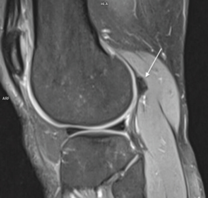 Figure 2: Magnetic resonance imaging of the knee showed the fabella bone (arrow) with no signs of knee dislocation or surrounding mass.