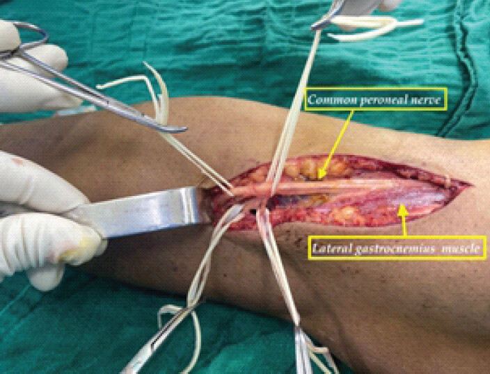 Figure 3: The intraoperative view after neurolysis of the common peroneal nerve.
