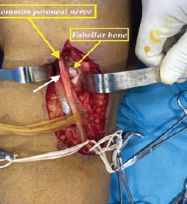 Figure 4: The intraoperative view showed the close contact between the nerve and the sesamoid bone. Note the impingement on the peroneal nerve’s path (white arrow).
