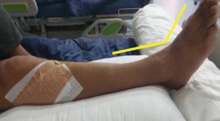 Figure 5: During post-operative care, we noticed a significant improvement in the nerve (note the yellow line).