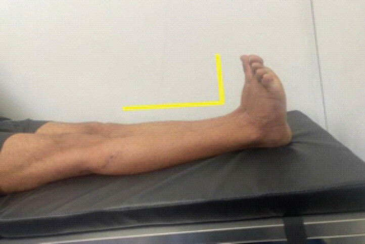 Figure 6: Complete restoration of motion in the foot compared to the contralateral foot after 6 months of follow-up.