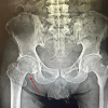 A Rare Case of Septic Arthritis of the Knee Associated with Pathological Neck of Femur Fracture Caused by Serratia Marcescens – A Case Report