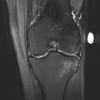 Two Cases of Anterolateral Meniscofemoral Ligament of the Lateral Meniscus