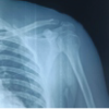 Clinical and Radiological Outcome Assessment following Coracoclavicular Reconstruction with Endobutton and Fibertape for Neer’s Type II Lateral End Clavicle Fracture: A Prospective Study.